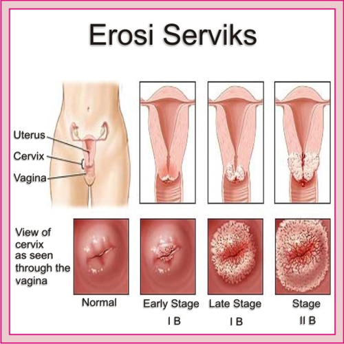 cara mengatasi sipilis secara alami