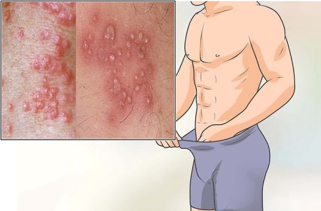 ciri sipilis mau sembuh