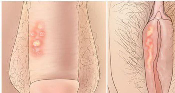 Obat Sipilis Kencing Nanah Di Apotik
